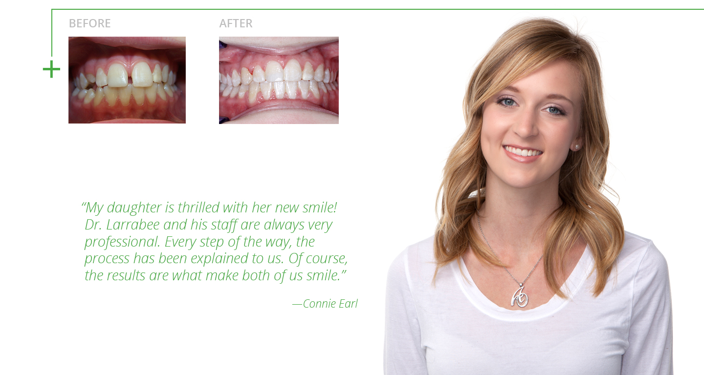 advanced-orthodontics-braces-before-and-after2