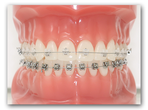 advanced-orthodontics-high-tech-braces