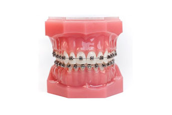 advanced-orthodontics-high-tech-braces-section