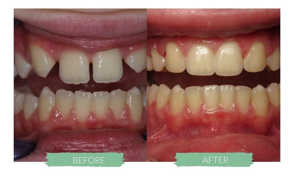 Invisalign before and after 1