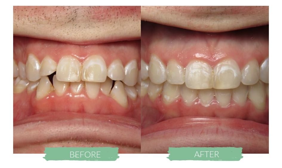 Invisalign Before and Afters 3