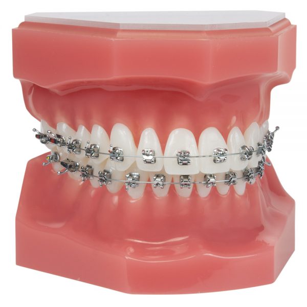 Ask Your Fort Worth Dentist: Should I Get Metal or Clear Braces? Archstone  Dental & Orthodontics, TX